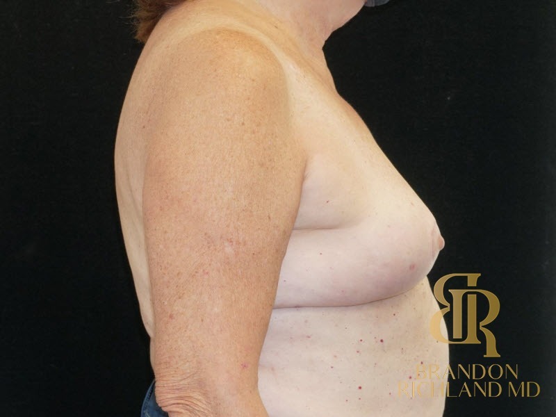 Breast Implant Removal After, Patient 05, view 3 — Dr. Brandon Richland, Newport Beach