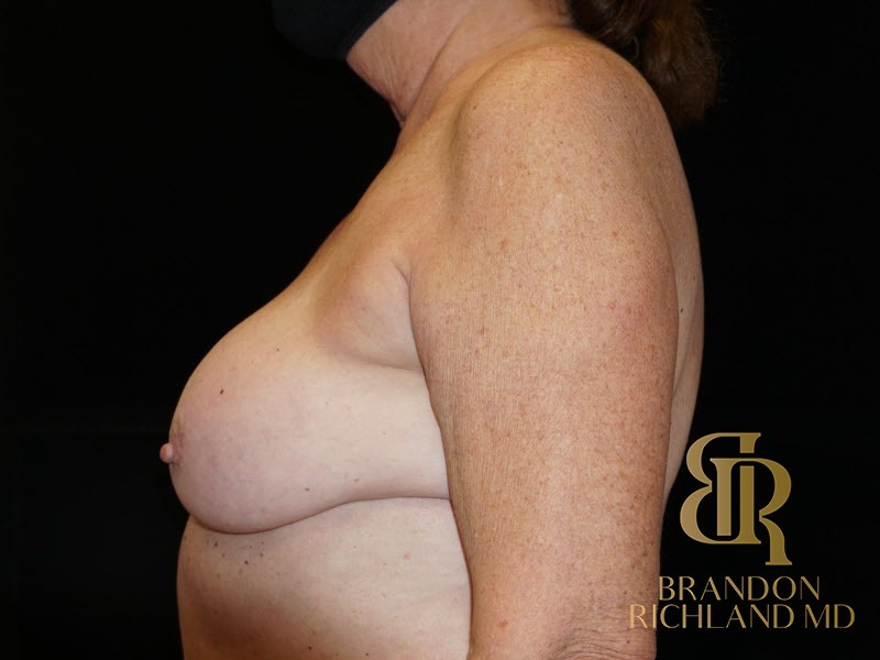 Breast Implant Removal Before, Patient 05, view 5 — Dr. Brandon Richland, Newport Beach