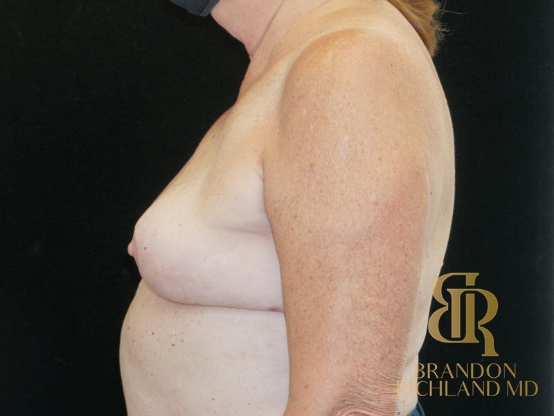 Breast Implant Removal After, Patient 05, view 5 — Dr. Brandon Richland, Newport Beach