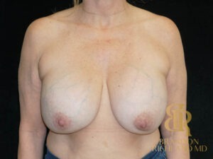 Breast Implant Removal before and after, Patient 06 — Dr. Brandon Richland, Newport Beach