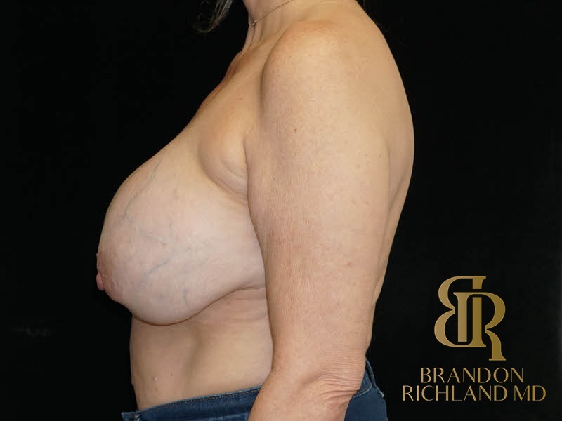 Breast Implant Removal Before, Patient 06, view 5 — Dr. Brandon Richland, Newport Beach