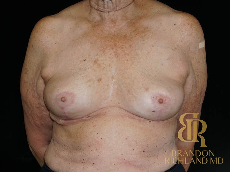 Breast Implant Removal After, Patient 08, view 1 — Dr. Brandon Richland, Newport Beach