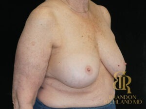 Breast Implant Removal before and after, Patient 08 — Dr. Brandon Richland, Newport Beach