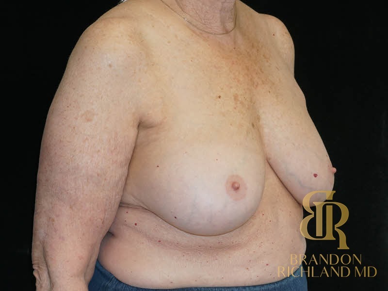 Breast Implant Removal Before, Patient 08, view 2 — Dr. Brandon Richland, Newport Beach