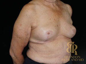 Breast Implant Removal before and after, Patient 08 — Dr. Brandon Richland, Newport Beach