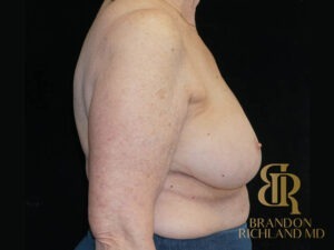 Breast Implant Removal before and after, Patient 08 — Dr. Brandon Richland, Newport Beach