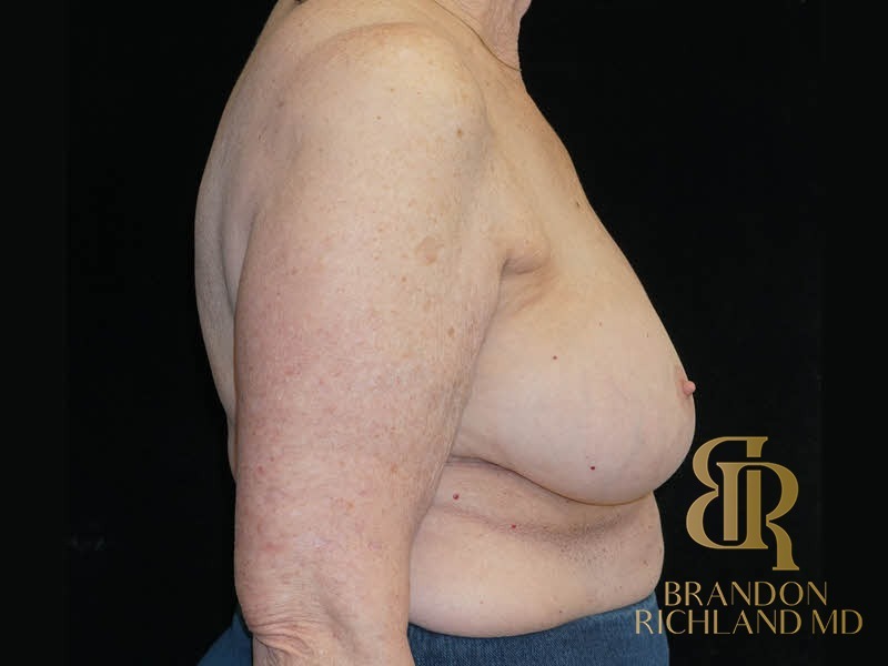 Breast Implant Removal Before, Patient 08, view 3 — Dr. Brandon Richland, Newport Beach