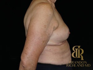 Breast Implant Removal before and after, Patient 08 — Dr. Brandon Richland, Newport Beach
