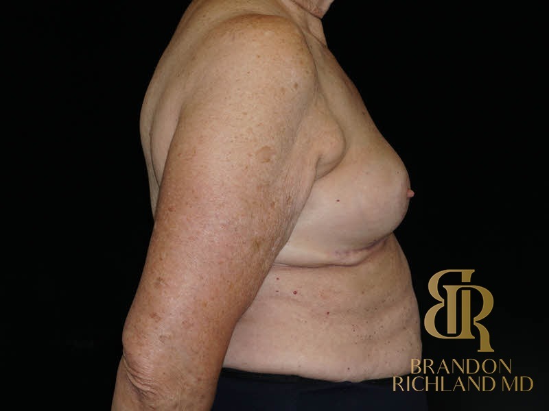 Breast Implant Removal After, Patient 08, view 3 — Dr. Brandon Richland, Newport Beach