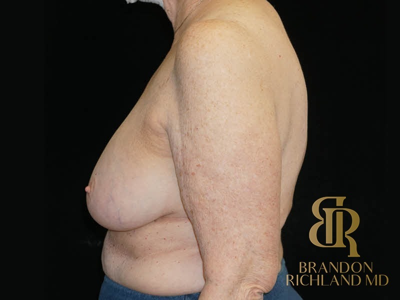 Breast Implant Removal Before, Patient 08, view 5 — Dr. Brandon Richland, Newport Beach