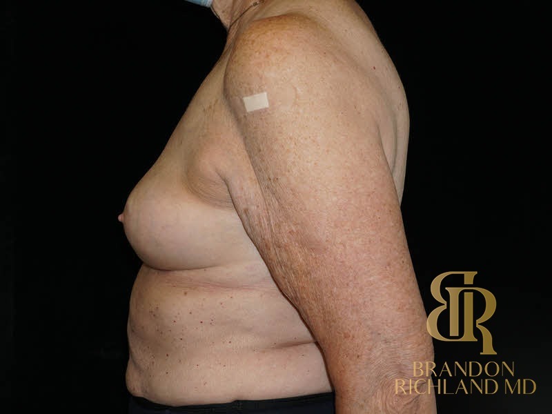 Breast Implant Removal After, Patient 08, view 5 — Dr. Brandon Richland, Newport Beach