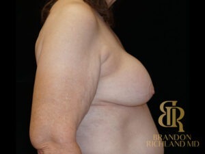 Breast Implant Removal before and after, Patient 10 — Dr. Brandon Richland, Newport Beach