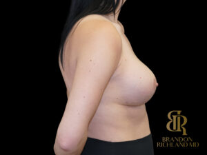 Breast Revision before and after, Case #10079 — Dr. Brandon Richland, Newport Beach