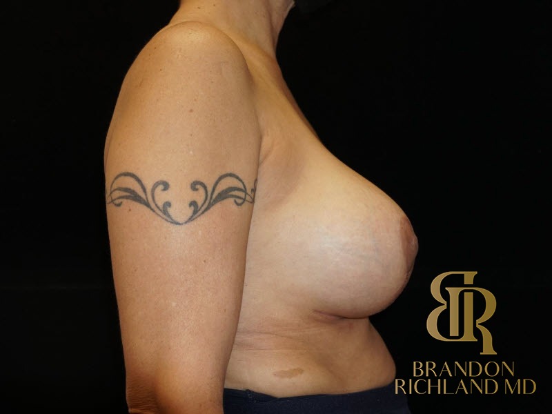 Breast Lift with Implants After, Patient 12, view 3 — Dr. Brandon Richland, Newport Beach