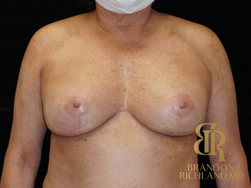 Breast Lift with Implants before and after, Patient 16 — Dr. Brandon Richland, Newport Beach
