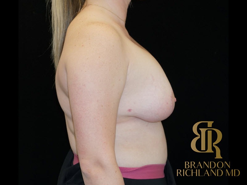 Breast Lift with Implants After, Patient 18, view 3 — Dr. Brandon Richland, Newport Beach