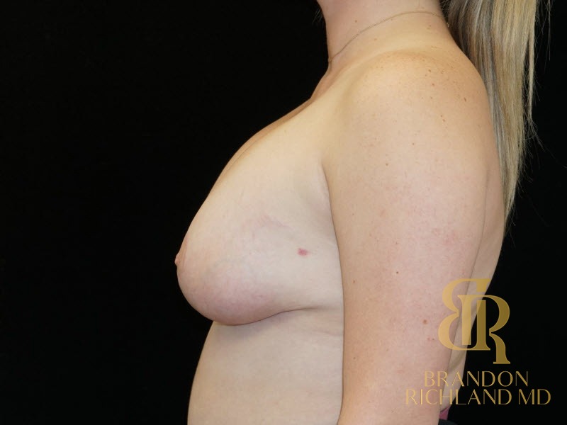 Breast Lift with Implants After, Patient 18, view 5 — Dr. Brandon Richland, Newport Beach