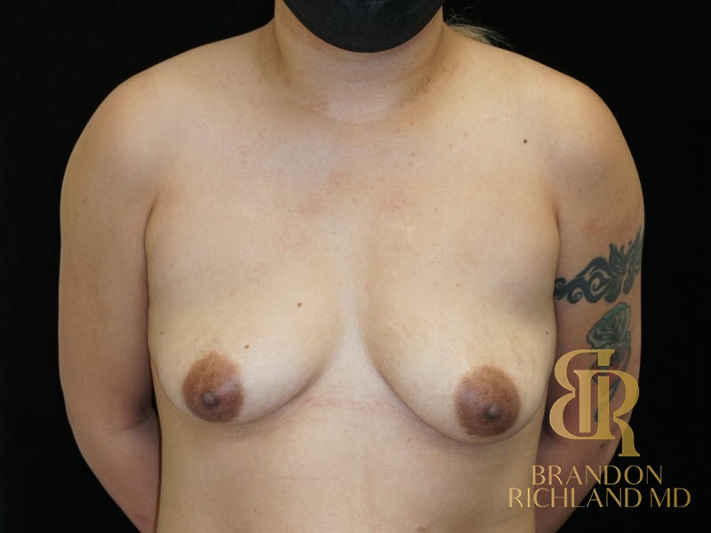 Breast Lift with Implants before and after, Patient 22 — Dr. Brandon Richland, Newport Beach