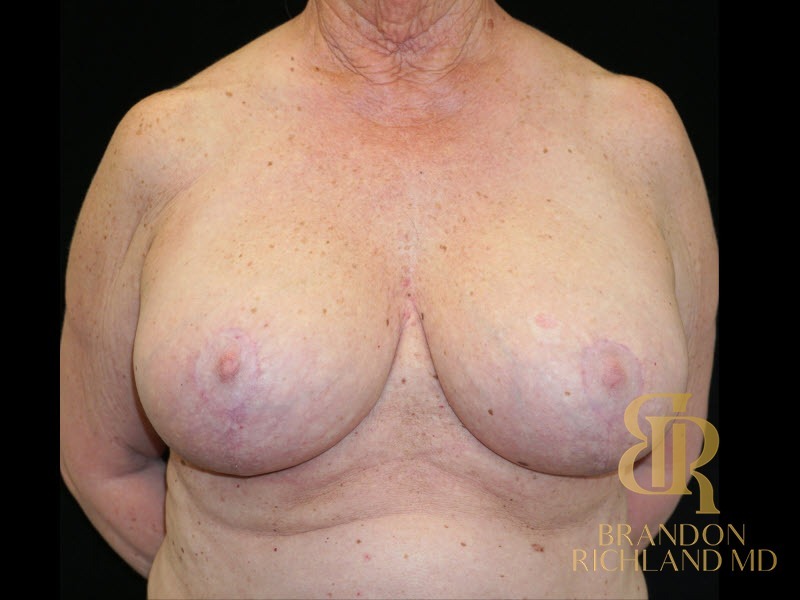 Breast Lift with Implants before and after, Patient 24 — Dr. Brandon Richland, Newport Beach