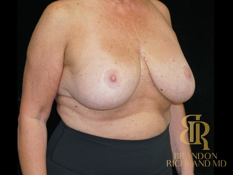 Breast Lift with Implants before and after, Patient 24 — Dr. Brandon Richland, Newport Beach