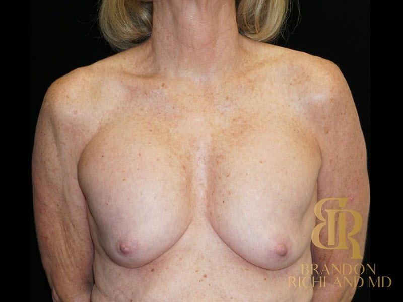 Breast Lift with Implants before and after, Patient 25 — Dr. Brandon Richland, Newport Beach