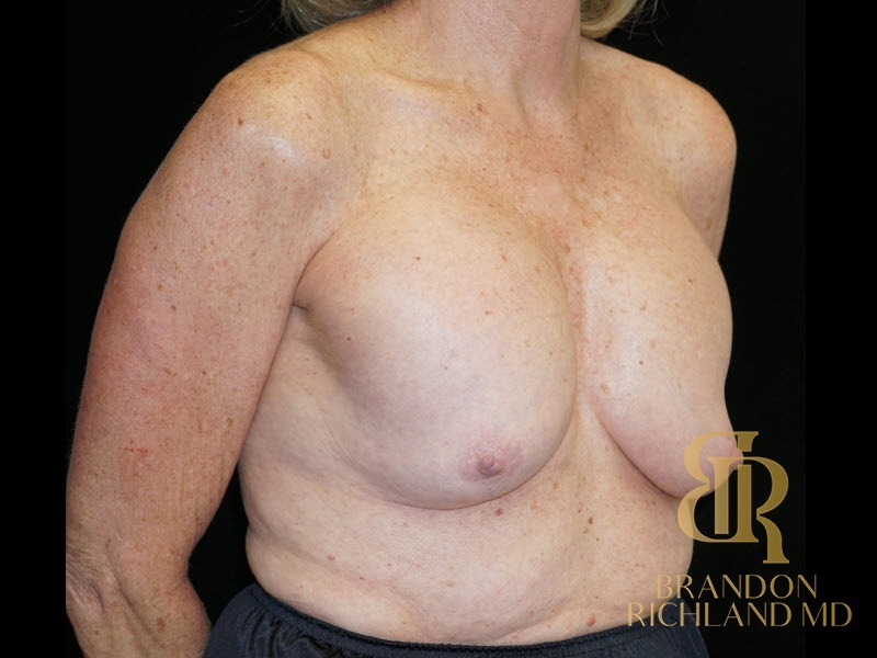 Breast Lift with Implants before and after, Patient 25 — Dr. Brandon Richland, Newport Beach