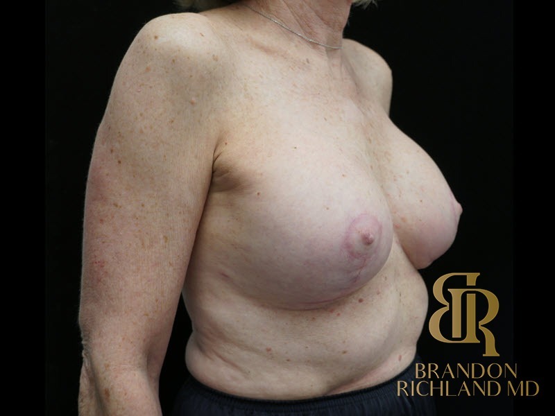 Breast Lift with Implants before and after, Patient 25 — Dr. Brandon Richland, Newport Beach