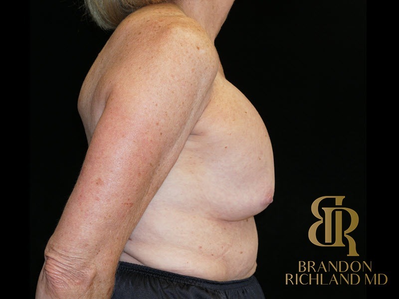 Breast Lift with Implants before and after, Patient 25 — Dr. Brandon Richland, Newport Beach