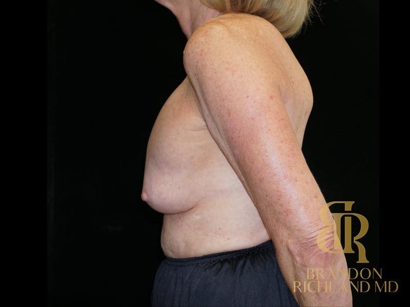 Breast Lift with Implants Before, Patient 25, view 5 — Dr. Brandon Richland, Newport Beach