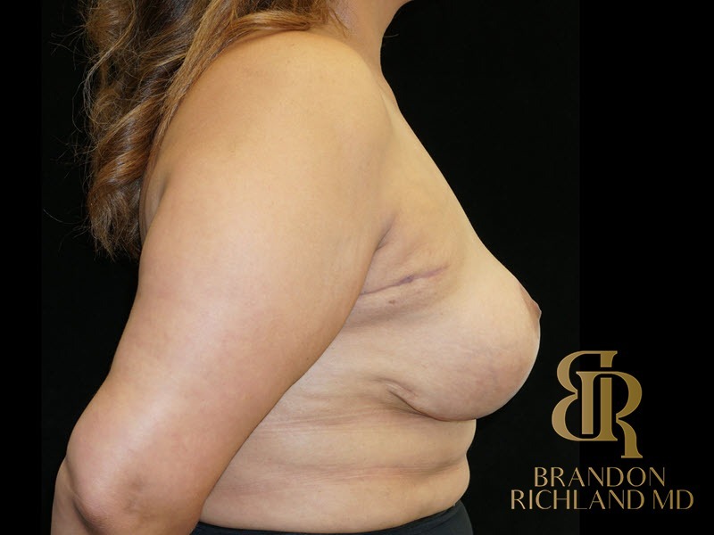 Breast Lift with Implants before and after, Patient 26 — Dr. Brandon Richland, Newport Beach