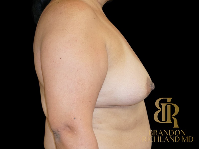 Breast Lift with Implants before and after, Patient 28 — Dr. Brandon Richland, Newport Beach