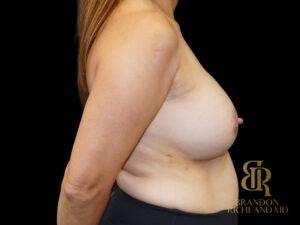 Breast Revision before and after, Case #28054 — Dr. Brandon Richland, Newport Beach