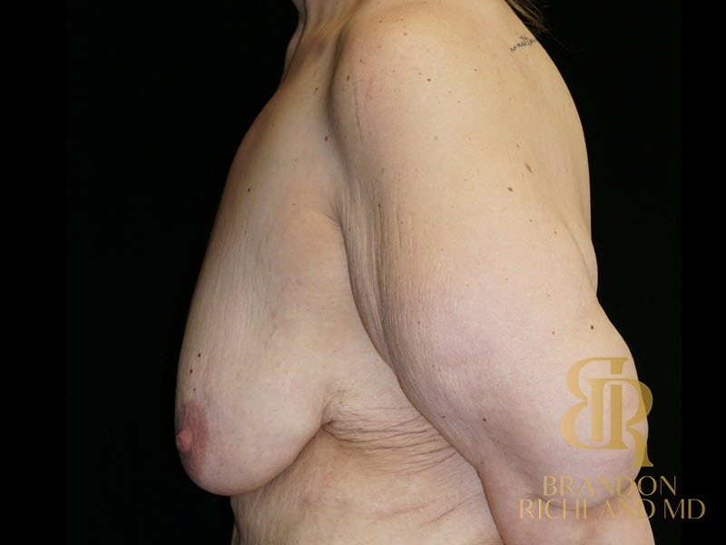 Breast Lift with Implants Before, Patient 30, view 5 — Dr. Brandon Richland, Newport Beach