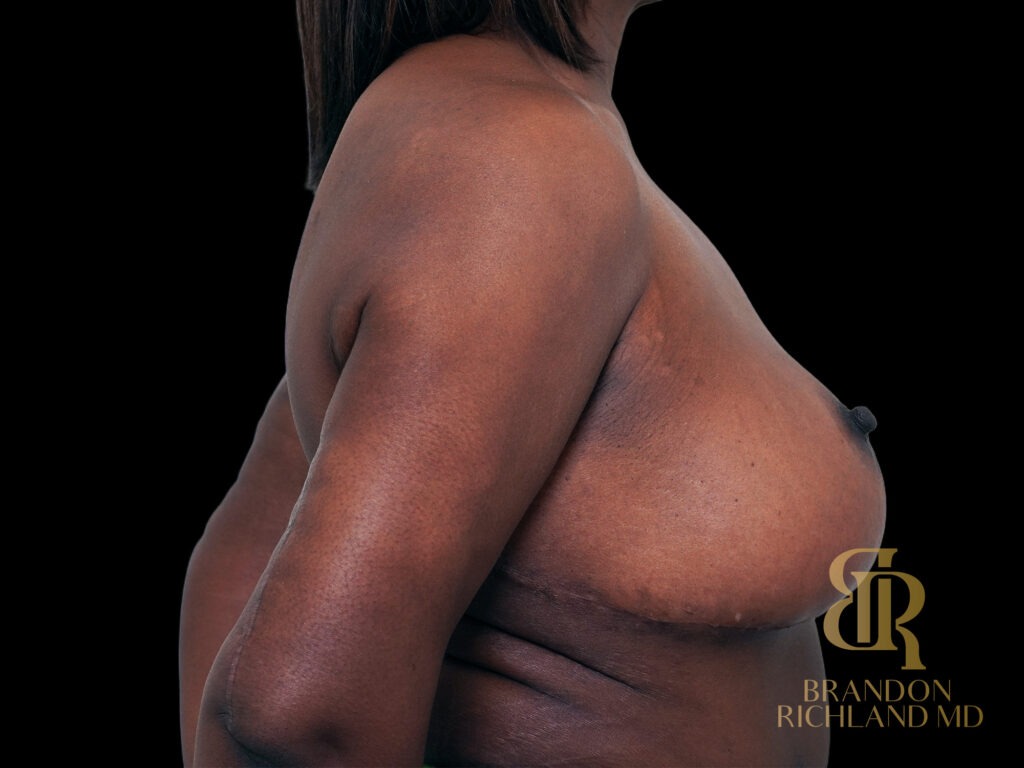 Breast Lift with Implants After, Case #47464, view 3 — Dr. Brandon Richland, Newport Beach