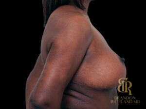 Liposuction before and after, Case #47464 — Dr. Brandon Richland, Newport Beach