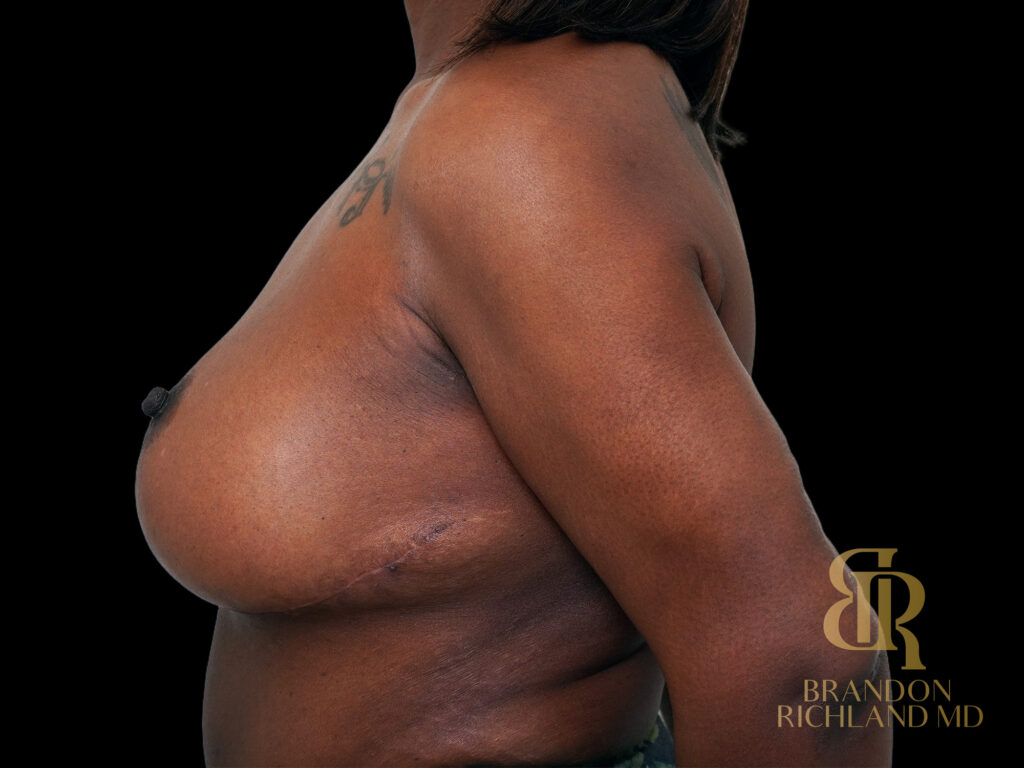 Breast Lift with Implants After, Case #47464, view 5 — Dr. Brandon Richland, Newport Beach