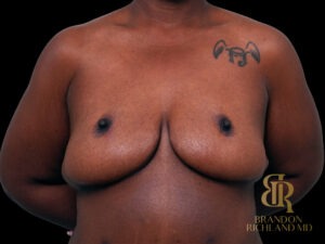 Liposuction before and after, Case #47464 — Dr. Brandon Richland, Newport Beach