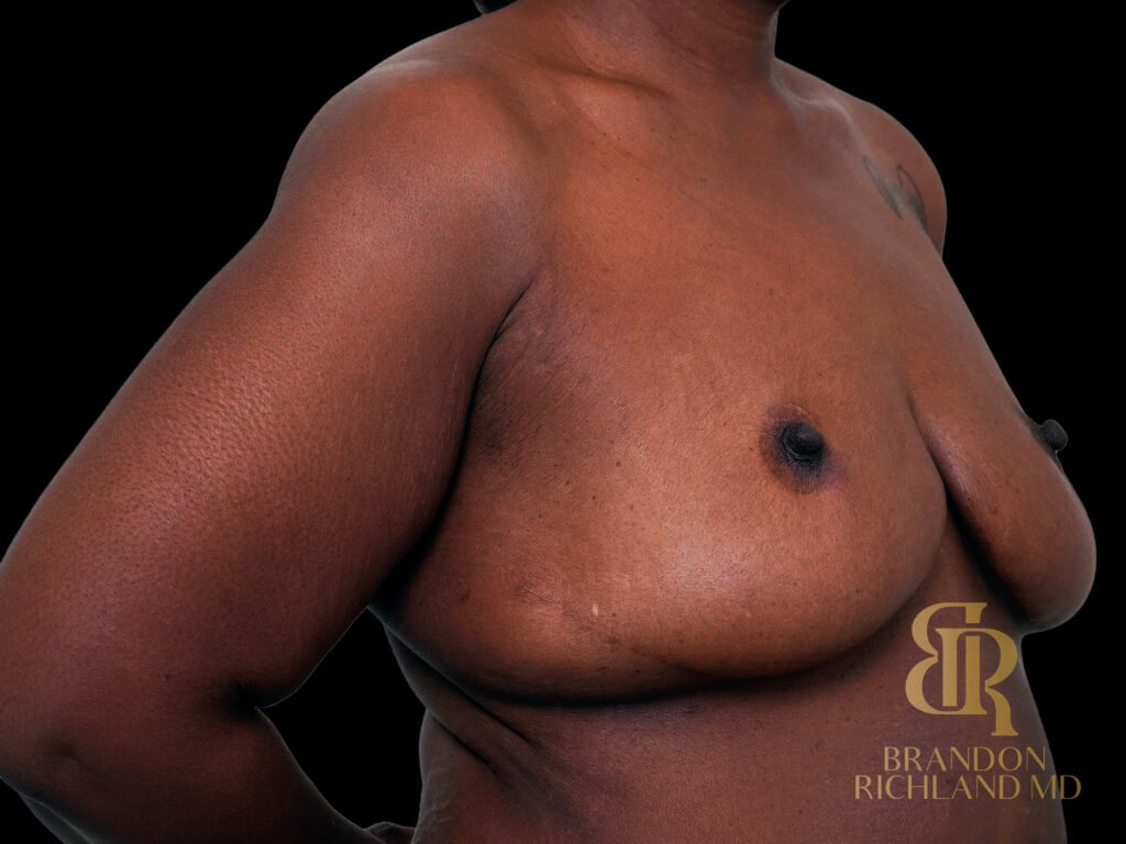 Breast Lift with Implants Before, Case #47464, view 2 — Dr. Brandon Richland, Newport Beach
