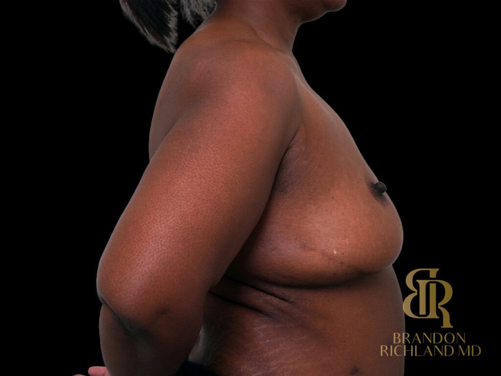 Breast Lift with Implants Before, Case #47464, view 3 — Dr. Brandon Richland, Newport Beach