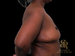 Liposuction before and after, Case #47464 — Dr. Brandon Richland, Newport Beach