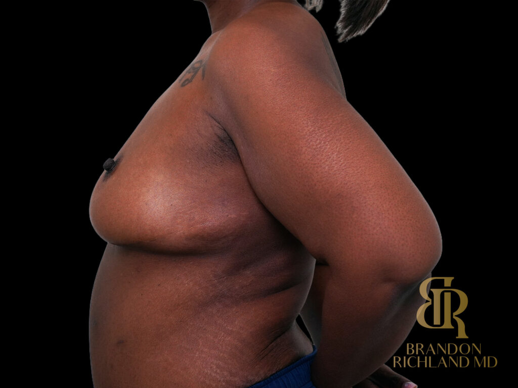 Breast Lift with Implants Before, Case #47464, view 5 — Dr. Brandon Richland, Newport Beach