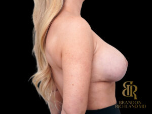 Breast Revision before and after, Case #65236 — Dr. Brandon Richland, Newport Beach