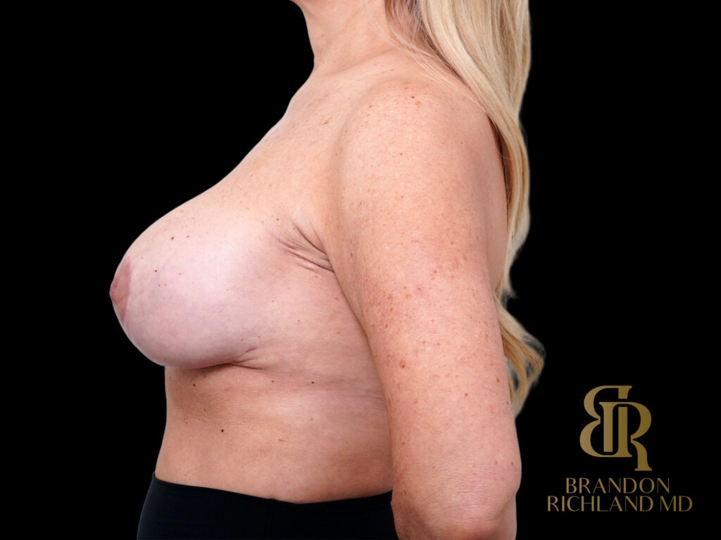 Breast Lift with Implants After, Case #65236, view 5 — Dr. Brandon Richland, Newport Beach