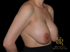Breast Revision before and after, Case #91051 — Dr. Brandon Richland, Newport Beach