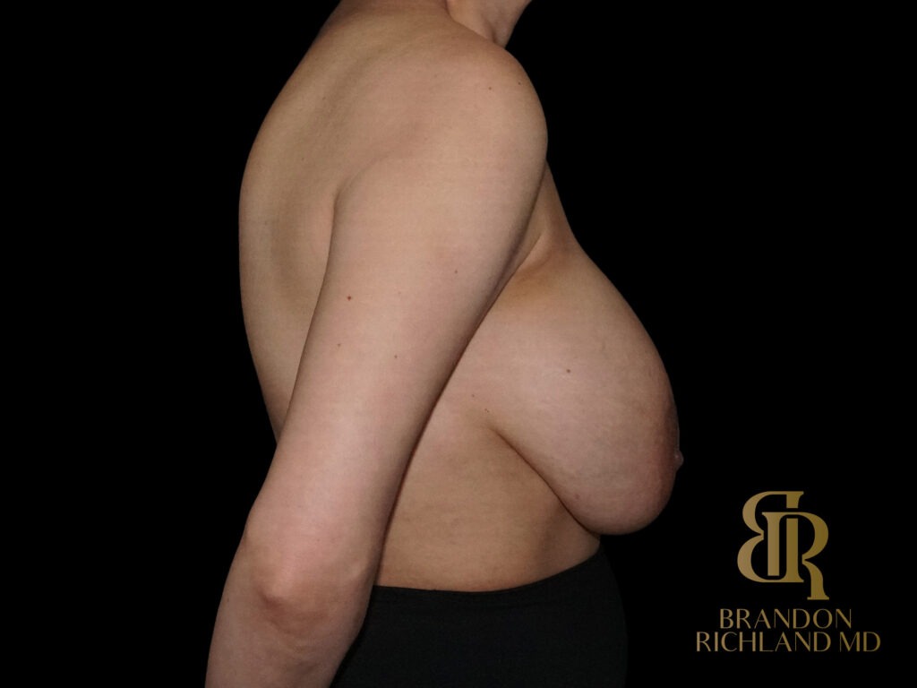 Breast Revision Before, Case #91051, view 3 — Dr. Brandon Richland, Newport Beach