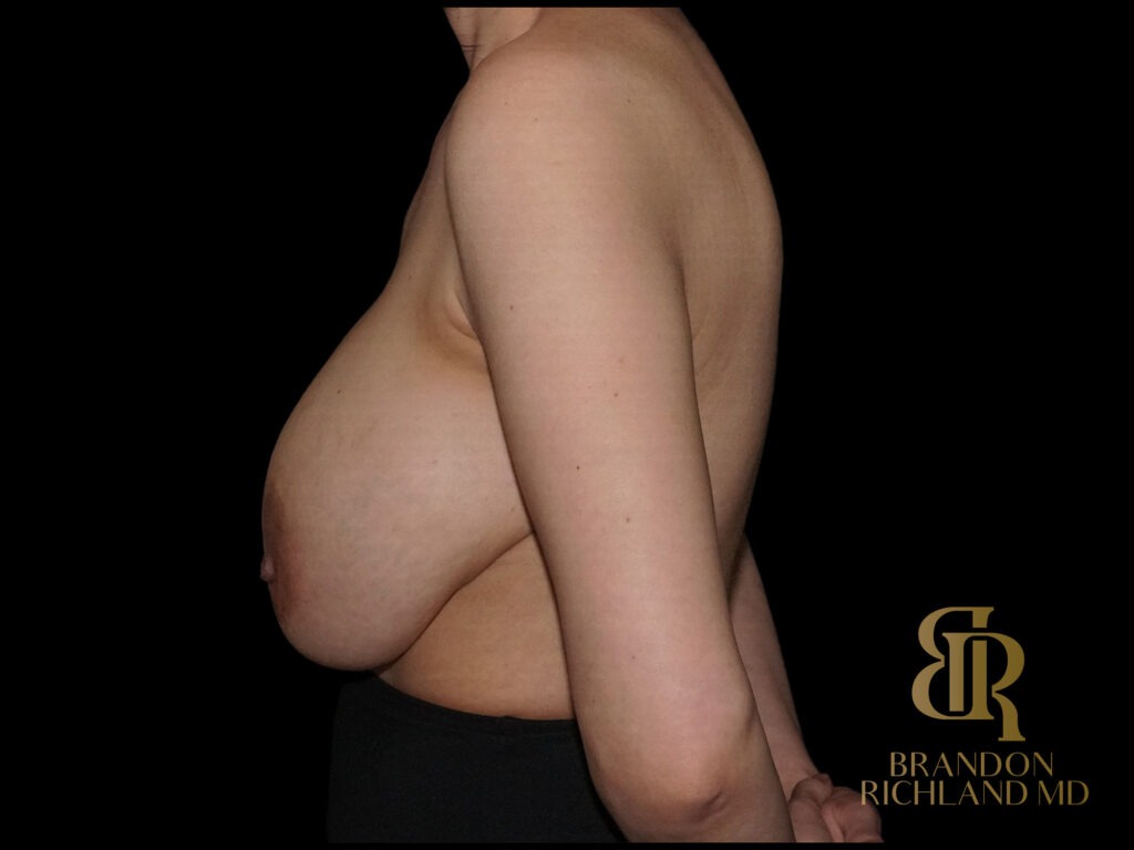 Breast Revision Before, Case #91051, view 5 — Dr. Brandon Richland, Newport Beach