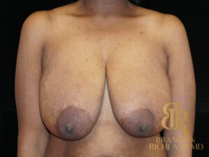Breast Lift before and after, Patient 06 — Dr. Brandon Richland, Newport Beach