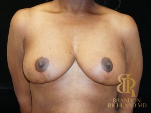 Breast Lift before and after, Patient 06 — Dr. Brandon Richland, Newport Beach