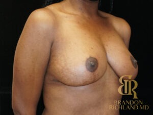 Breast Lift before and after, Patient 06 — Dr. Brandon Richland, Newport Beach