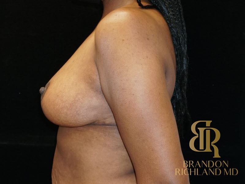 Breast Lift After, Patient 06, view 5 — Dr. Brandon Richland, Newport Beach